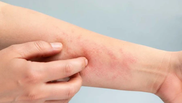 Urticaria y angioedema